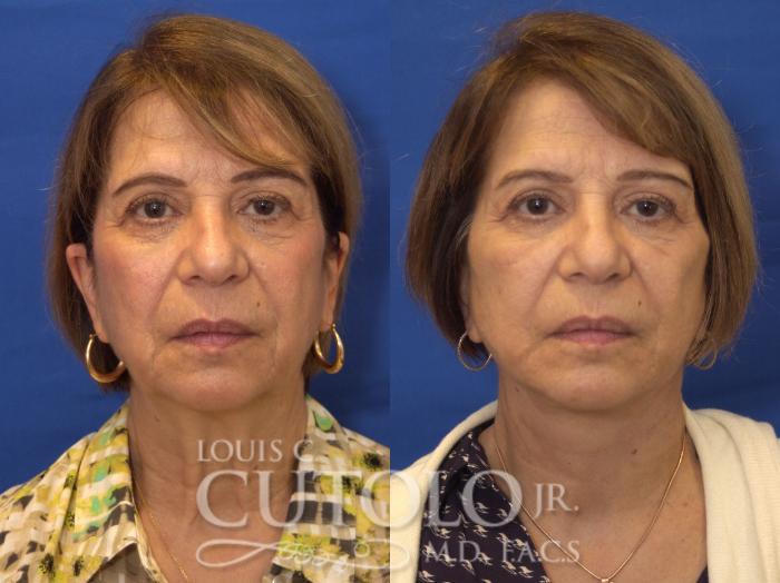 Louis Cutolo, MD facelift result — Staten Island, NY