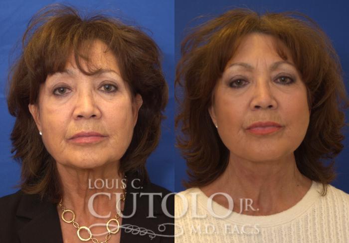 Louis Cutolo, MD facelift result — Staten Island, NY