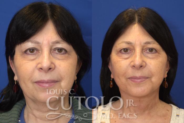 Louis Cutolo, MD facelift result — Staten Island, NY