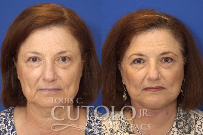 Louis Cutolo, MD facelift result — Staten Island, NY