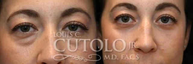 Blepharoplasty result at Louis Cutolo, MD in Staten Island, NY