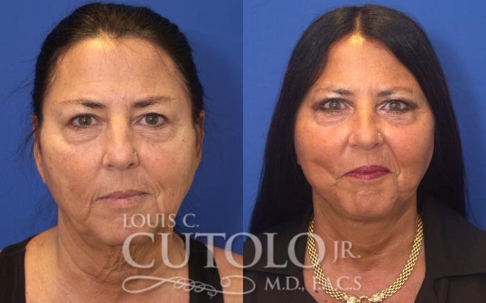 Louis Cutolo, MD facelift result — Staten Island, NY