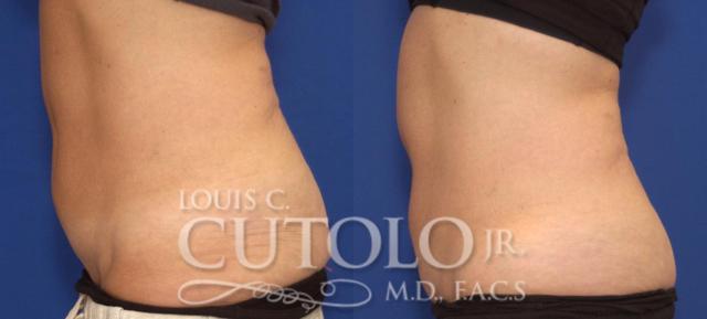 CoolSculpting result at Louis Cutolo, MD in Staten Island, NY