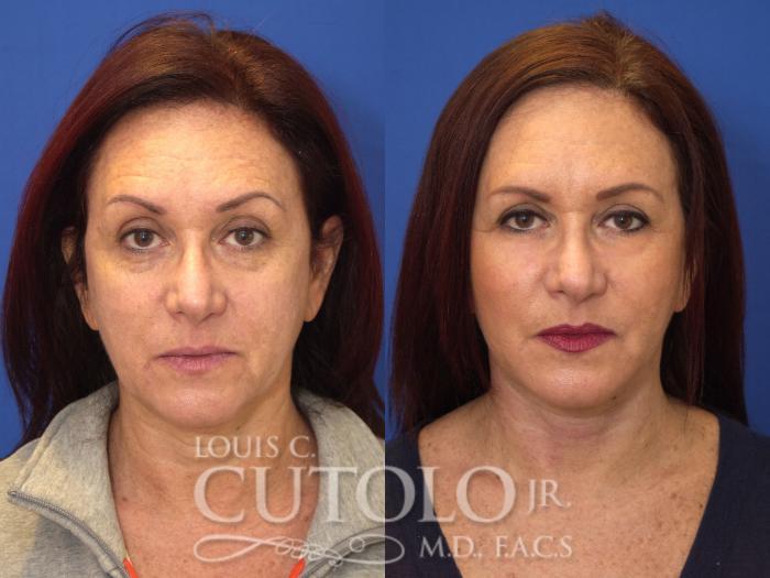 Louis Cutolo, MD facelift result — Staten Island, NY