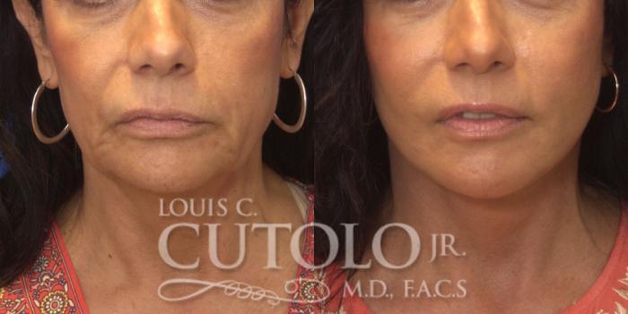 Louis Cutolo, MD tummy tuck result — Staten Island, NY