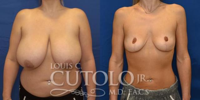 Breast Reduction result at Louis Cutolo, MD in Staten Island, NY