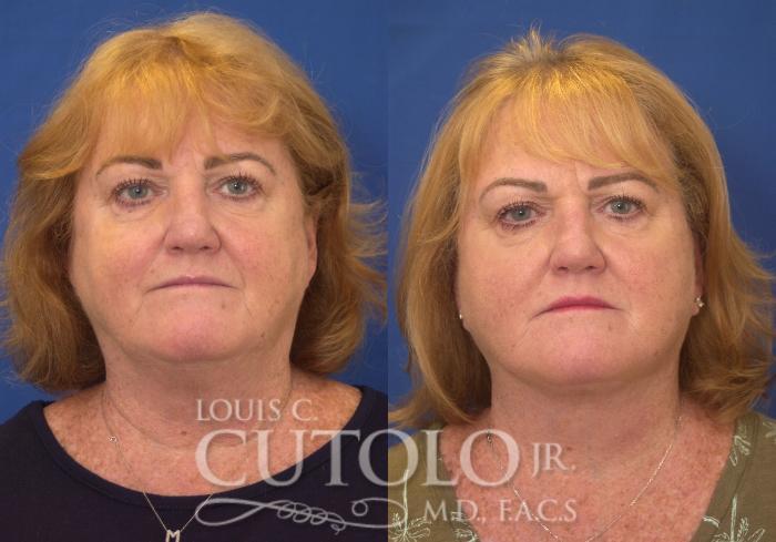 Louis Cutolo, MD facelift result — Staten Island, NY