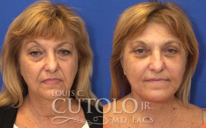 Louis Cutolo, MD facelift result — Staten Island, NY
