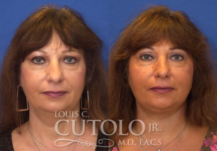 Louis Cutolo, MD facelift result — Staten Island, NY