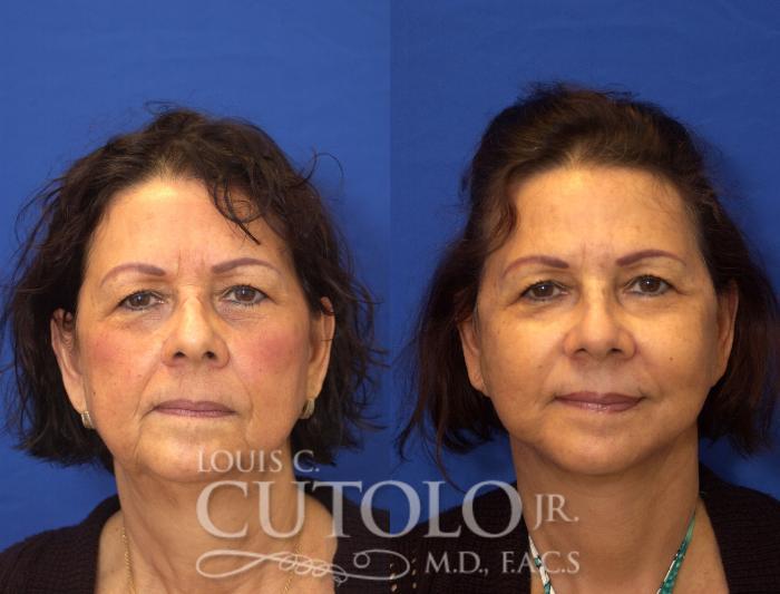 Louis Cutolo, MD facelift result — Staten Island, NY