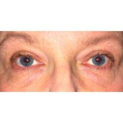 Facial Plastic Surgeon Winnetka: Dr. Paul Phelps blepharoplasty after — Winnetka, IL