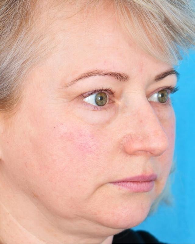 Deep Plane Facelift before at Facial Plastic Surgeon Winnetka: Dr. Paul Phelps in Winnetka, IL