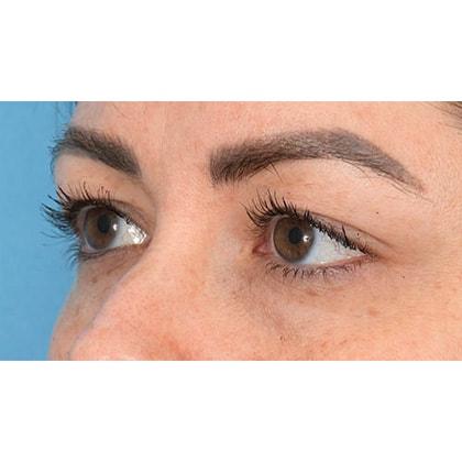 Blepharoplasty before at Facial Plastic Surgeon Winnetka: Dr. Paul Phelps in Winnetka, IL