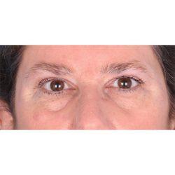 Facial Plastic Surgeon Winnetka: Dr. Paul Phelps blepharoplasty after — Winnetka, IL