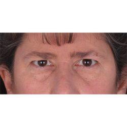 Blepharoplasty before at Facial Plastic Surgeon Winnetka: Dr. Paul Phelps in Winnetka, IL