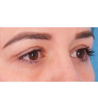 Facial Plastic Surgeon Winnetka: Dr. Paul Phelps eyelid lift after — Winnetka, IL