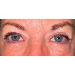 Facial Plastic Surgeon Winnetka: Dr. Paul Phelps blepharoplasty after — Winnetka, IL