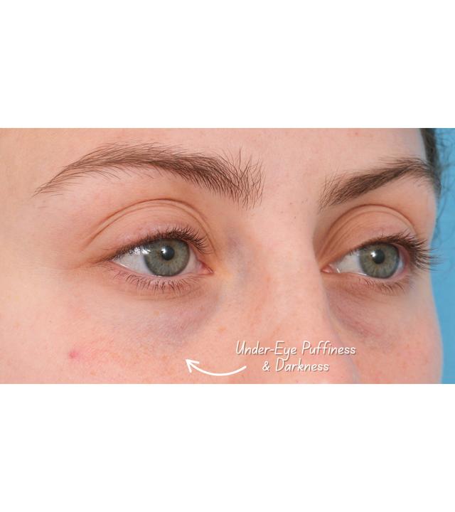 Morpheus8 before at Facial Plastic Surgeon Winnetka: Dr. Paul Phelps in Winnetka, IL