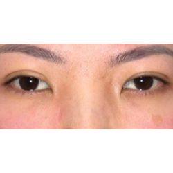 Blepharoplasty after at Facial Plastic Surgeon Winnetka: Dr. Paul Phelps in Winnetka, IL
