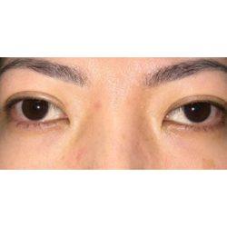 Blepharoplasty before at Facial Plastic Surgeon Winnetka: Dr. Paul Phelps in Winnetka, IL