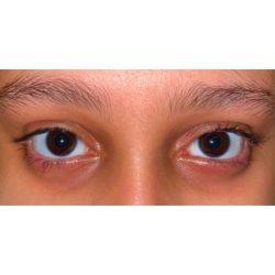 Blepharoplasty after at Facial Plastic Surgeon Winnetka: Dr. Paul Phelps in Winnetka, IL