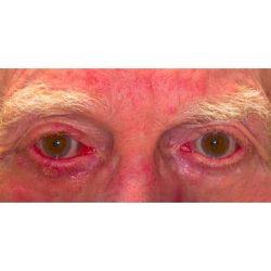 Facial Plastic Surgeon Winnetka: Dr. Paul Phelps blepharoplasty after — Winnetka, IL