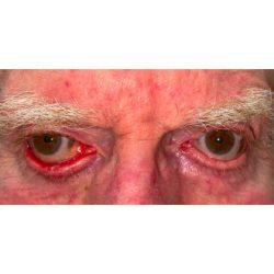 Blepharoplasty before at Facial Plastic Surgeon Winnetka: Dr. Paul Phelps in Winnetka, IL