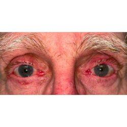 Facial Plastic Surgeon Winnetka: Dr. Paul Phelps blepharoplasty after — Winnetka, IL