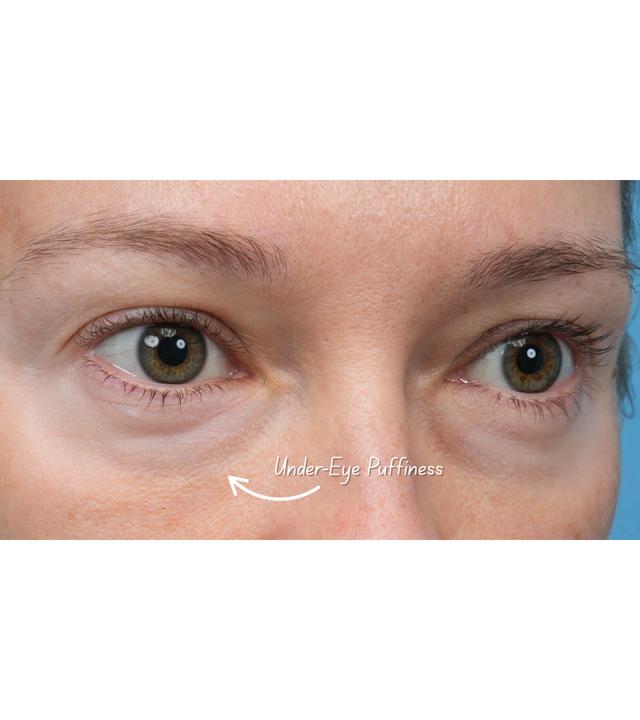Microneedling before at Facial Plastic Surgeon Winnetka: Dr. Paul Phelps in Winnetka, IL