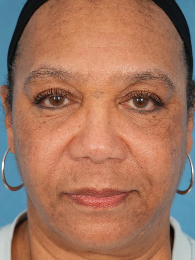 Morpheus8 after at Facial Plastic Surgeon Winnetka: Dr. Paul Phelps in Winnetka, IL