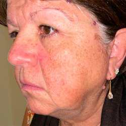 Neck Lift before at Facial Plastic Surgeon Winnetka: Dr. Paul Phelps in Winnetka, IL