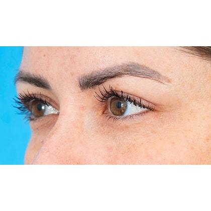 Facial Plastic Surgeon Winnetka: Dr. Paul Phelps eyelid lift after — Winnetka, IL