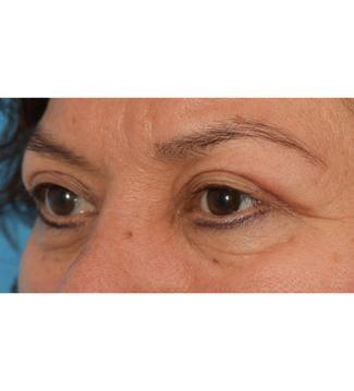 Facial Plastic Surgeon Winnetka: Dr. Paul Phelps eyelid lift after — Winnetka, IL