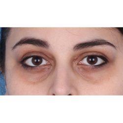 Facial Plastic Surgeon Winnetka: Dr. Paul Phelps after — Winnetka, IL