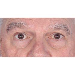 Facial Plastic Surgeon Winnetka: Dr. Paul Phelps after — Winnetka, IL