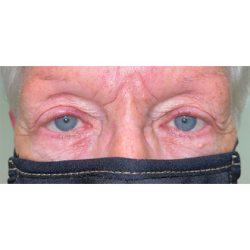 Facial Plastic Surgeon Winnetka: Dr. Paul Phelps after — Winnetka, IL