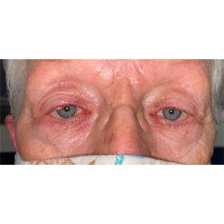 Blepharoplasty before at Facial Plastic Surgeon Winnetka: Dr. Paul Phelps in Winnetka, IL