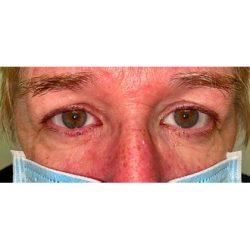 Facial Plastic Surgeon Winnetka: Dr. Paul Phelps after — Winnetka, IL