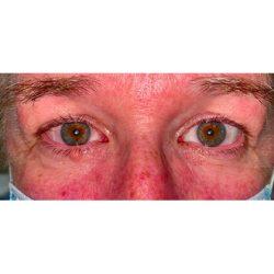 Blepharoplasty before at Facial Plastic Surgeon Winnetka: Dr. Paul Phelps in Winnetka, IL