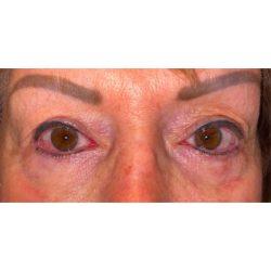 Facial Plastic Surgeon Winnetka: Dr. Paul Phelps blepharoplasty after — Winnetka, IL