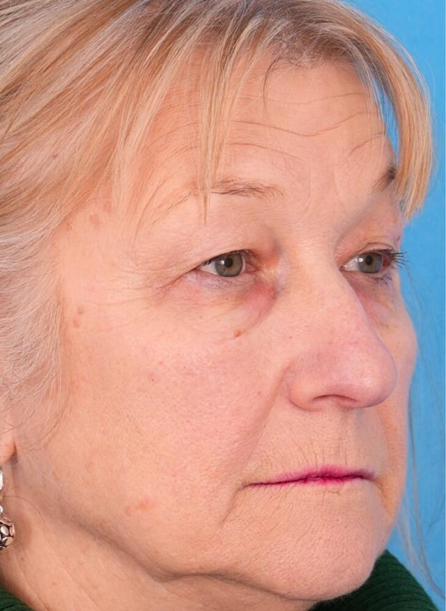 Deep Plane Facelift before at Facial Plastic Surgeon Winnetka: Dr. Paul Phelps in Winnetka, IL