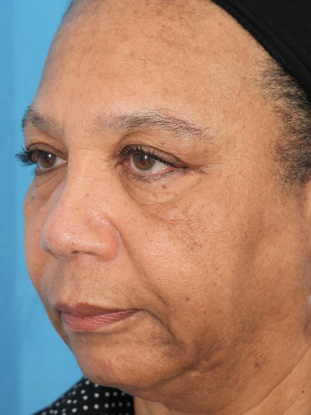 Morpheus8 before at Facial Plastic Surgeon Winnetka: Dr. Paul Phelps in Winnetka, IL