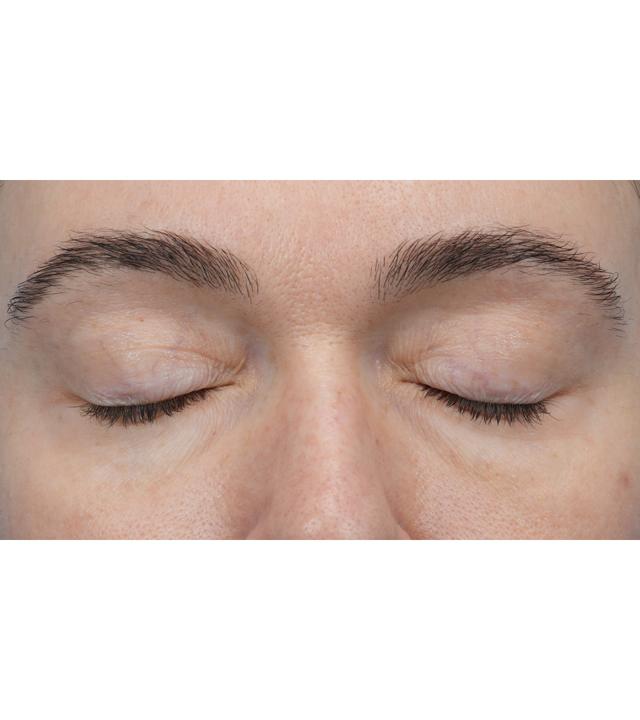 Laser Skin Resurfacing before at Facial Plastic Surgeon Winnetka: Dr. Paul Phelps in Winnetka, IL