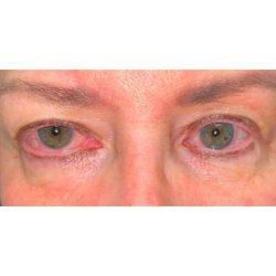 Blepharoplasty before at Facial Plastic Surgeon Winnetka: Dr. Paul Phelps in Winnetka, IL