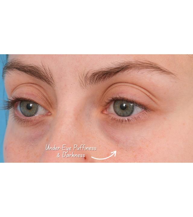 Morpheus8 before at Facial Plastic Surgeon Winnetka: Dr. Paul Phelps in Winnetka, IL