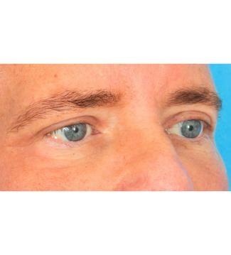 Facial Plastic Surgeon Winnetka: Dr. Paul Phelps eyelid lift after — Winnetka, IL