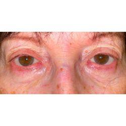 Facial Plastic Surgeon Winnetka: Dr. Paul Phelps blepharoplasty after — Winnetka, IL
