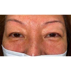 Facial Plastic Surgeon Winnetka: Dr. Paul Phelps after — Winnetka, IL