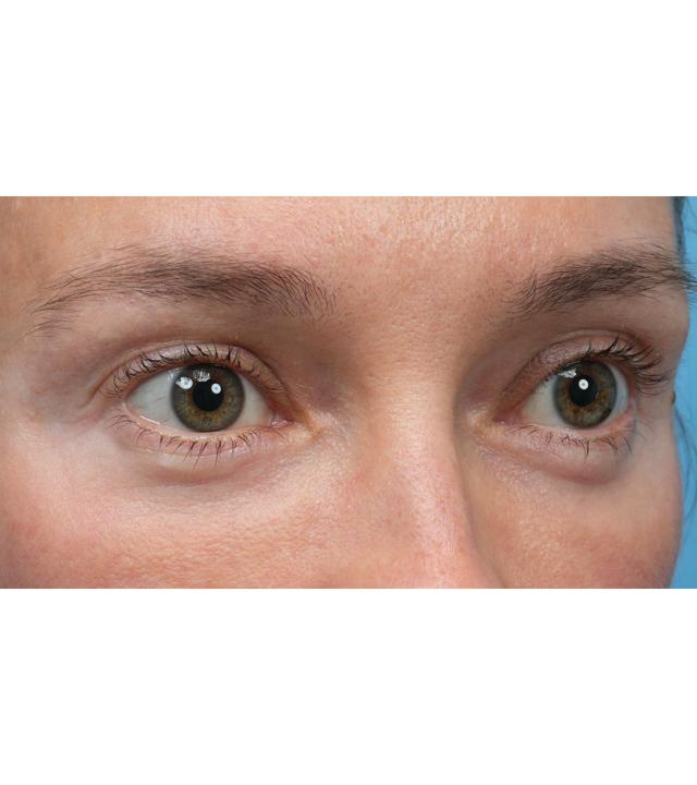 Microneedling after at Facial Plastic Surgeon Winnetka: Dr. Paul Phelps in Winnetka, IL