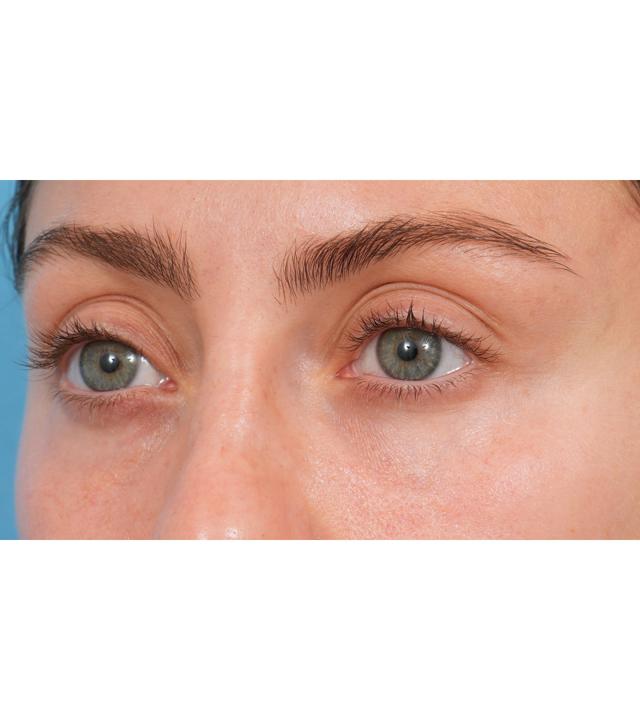 Morpheus8 after at Facial Plastic Surgeon Winnetka: Dr. Paul Phelps in Winnetka, IL